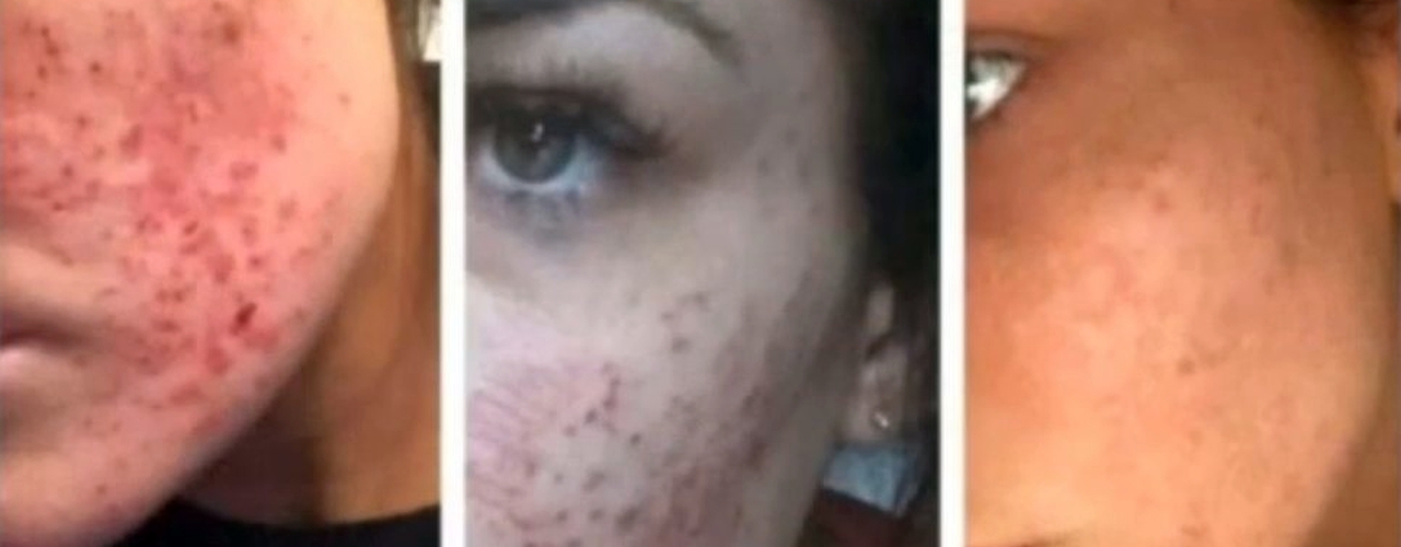 laser skin treatment