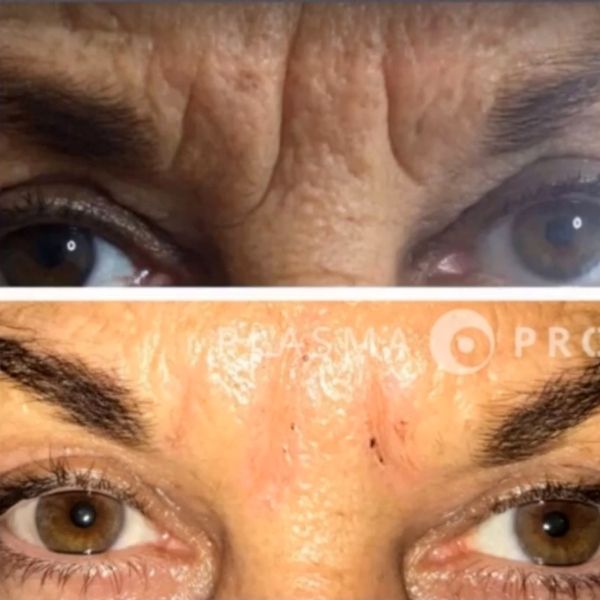 daffodil plasma pro 1