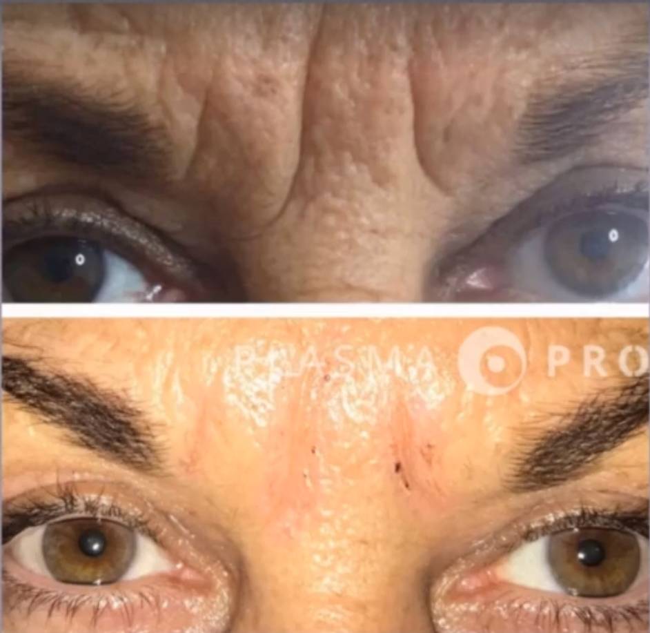 daffodil plasma pro 1 lr